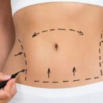 Does Medicaid Cover A Tummy Tuck