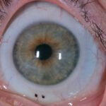 Does Medicare Cover Contact Lenses For Keratoconus?