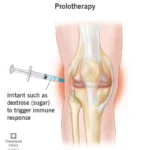 Does Medicare Cover Prolotherapy?