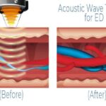 acoustic wave therapy for ed graphic