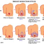 breast reduction incision