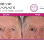 eyelid surgery before and after brisbane.jpg