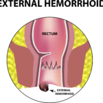 hemorrhoid illustration