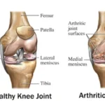 knee joint e1647111004343